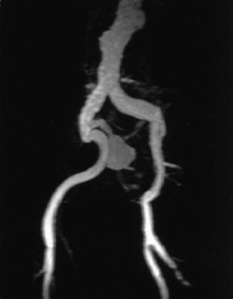 Endovascular Treatment of Iliac Artery Aneurysms | RadioGraphics