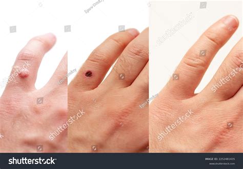 Wart Removal