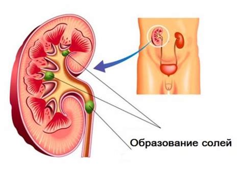 Соли в почках: причины, симптомы, лечение, диета