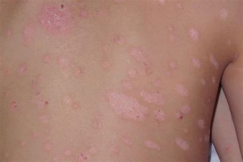 Scalp Psoriasis In Children Pictures