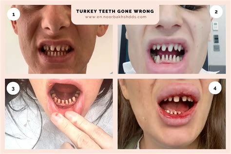 What Are Turkey Teeth? Getting to the Truth.