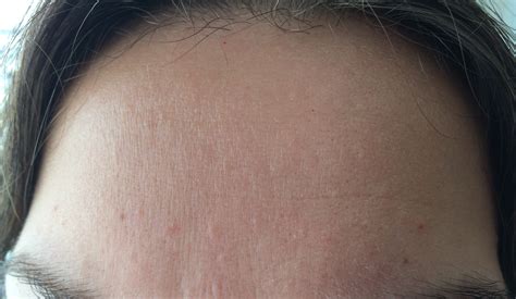 Small Flesh Colored Bumps on Forehead and Hairline – Adult acne – Acne.org Forum