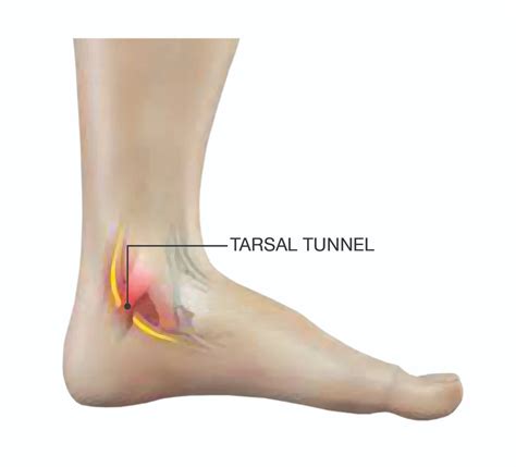 Tarsal Tunnel Syndrome - Symmetry Physical Therapy | Miami - tarsal tunnel syndrome remedies