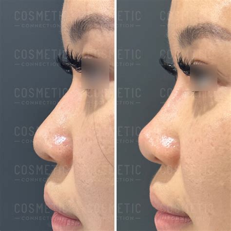 Non-Surgical Rhinoplasty Guide for Asian Noses