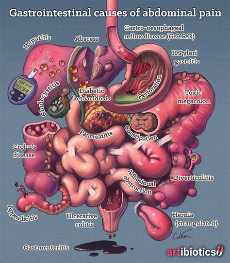 Gastrointestinal causes of abdominal pain, by Dr Cilein Kearns (artibiotics) Nursing School ...