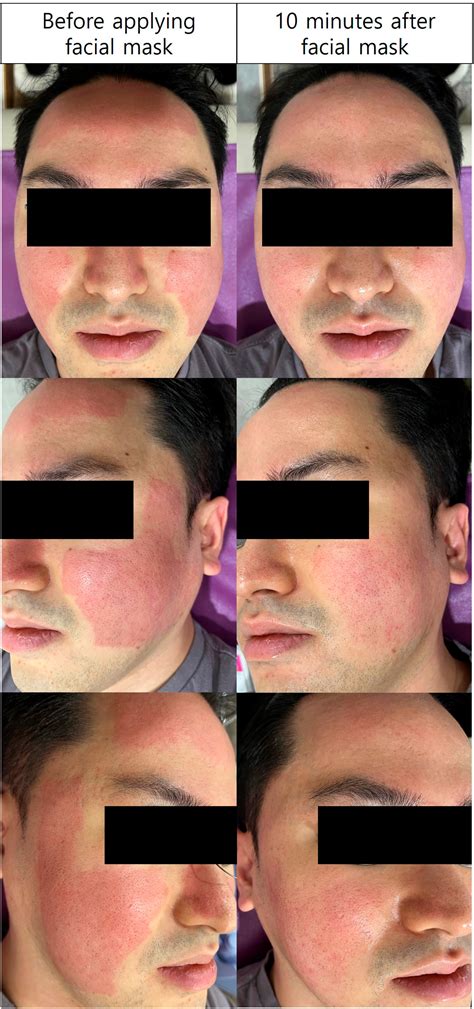 Effects of a facial mask containing zinc oxide‐based cream on improving post‐laser skin care ...