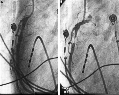 Sotalol associated polymorphic ventricular tachycardia and coronary ...