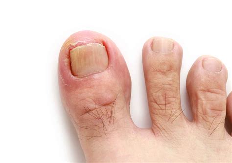 How Do I Know If I Have an Ingrown Toenail Infection? | 2bstronger.com