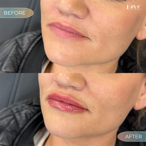 Lip Filler Before And After | Natural Results In Orlando, FL