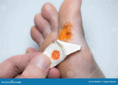 Contagious Skin Illness on Foot. Medical Treatment Photo..Close Up Photo of Plantar Wart on Man ...