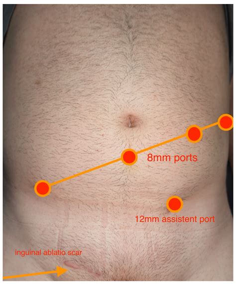 Robotic Retroperitoneal Lymph Node Dissection for Testicular Cancer—First Experience and ...
