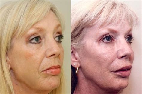 Prescription Wrinkle Injections Before and After Photo Gallery ...