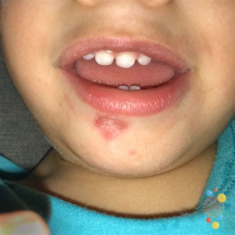 Impetigo Lips Icd 10 | Lipstutorial.org