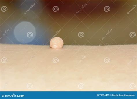 Skin Tag or Acrochondon or Soft Fibroma Stock Image - Image of care ...