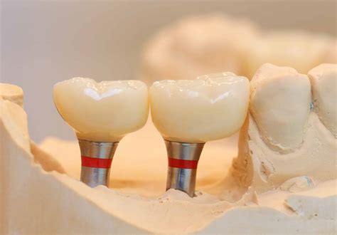 Manufacturing and installation of permanent zirconia crowns on implants | сases of the Polar ...