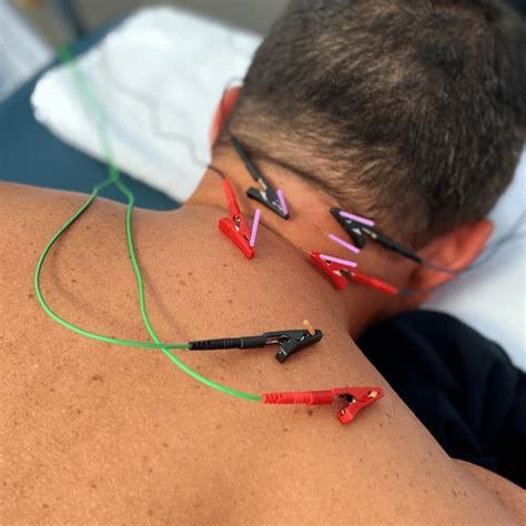 Orlando Dry Needling | Pursuit Physical Therapy