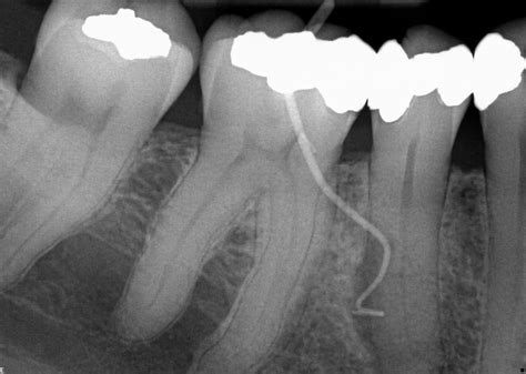Endodontics 101 – understanding the basic principles - Dentistry