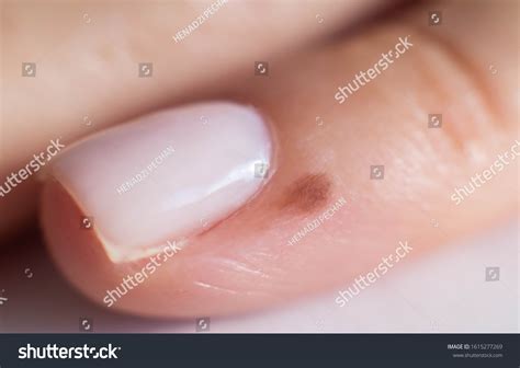 81 Nail Melanoma Images, Stock Photos & Vectors | Shutterstock