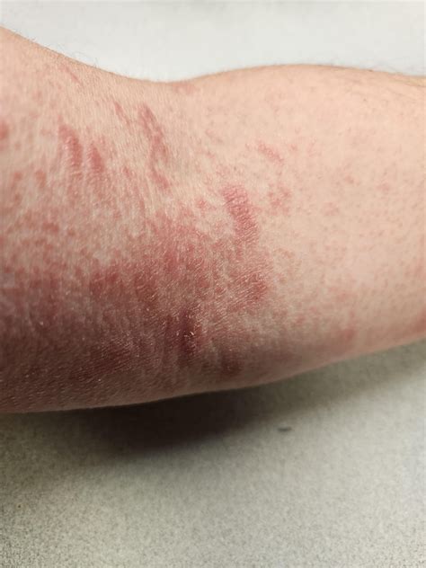 Pityriasis Rosea Swimming Pool at Harold Cheever blog