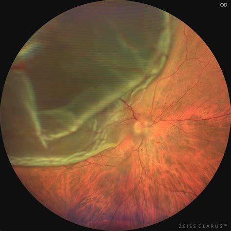 Desprendimiento de retina: tratamiento de vanguardia en Tijuana