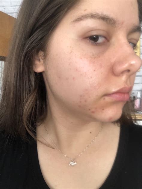 [Routine Help] hyperpigmentation and acne (routine/details in comments) : r/SkincareAddiction