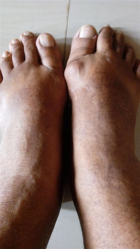 Seek remedy for freckle like black spots on feet