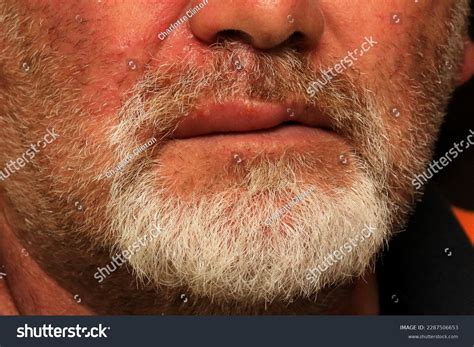 Man Herpes Zoster Shingles On Face Stock Photo 2287506653 | Shutterstock
