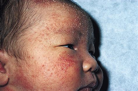 Congenital Cutaneous Lesions and Infantile Rashes - Clinical Tree
