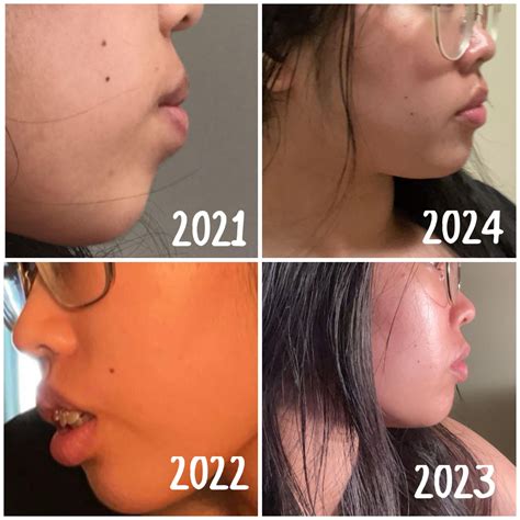 Side profile before and after 4 premolar extractions : r/braces