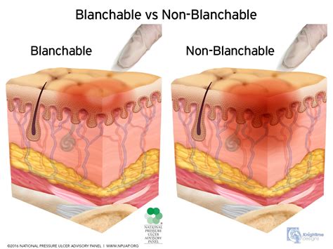 Non Blanchable Redness