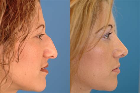 Rhinoplasty Before & After Photos | Dr. Benjamin Bassichis