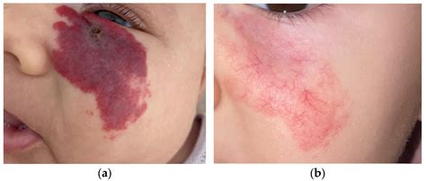 Diagnosis and Treatment of Infantile Hemangioma from the Primary Care Paediatricians to the ...