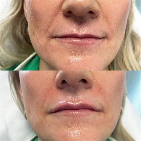 Lip Flip Before and After - Before After Journey