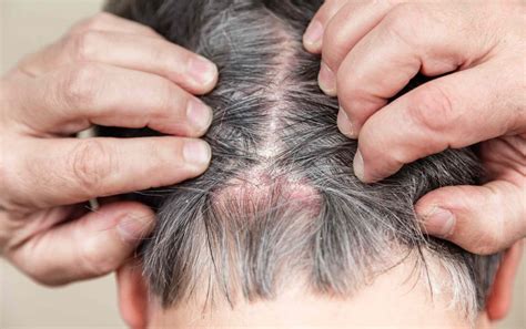Causes of Scalp Scabs and How to Treat Them | Hiswai