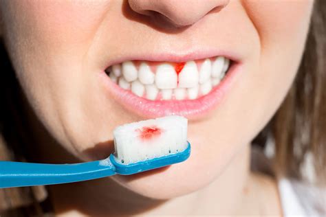 How to Stop Gum Bleeding Immediately | Teeth Cleaning | TX