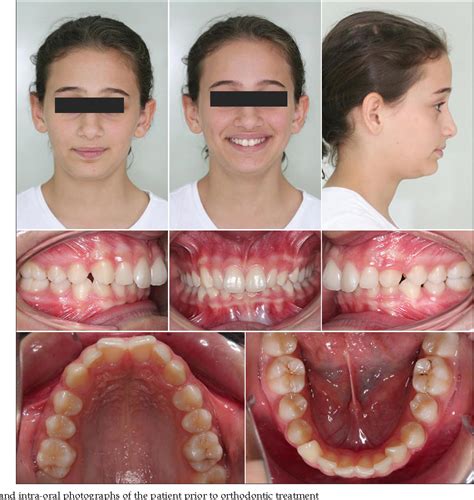 Figure 3 from Treatment of a skeletal Class II malocclusion using fixed ...