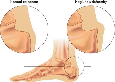 Lump on Achilles Tendon: Causes, Symptoms, and Recommended Podiatry Treatments