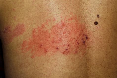 Shingles Rash Shingles Dr Bruce Robinson