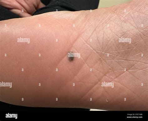 Mole on the sole of a patient's foot. This skin mark is caused by a proliferation of the ...