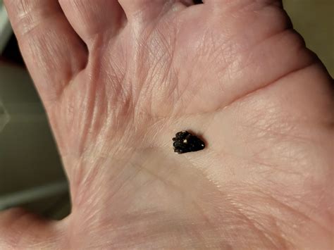 8Mm Kidney Stone