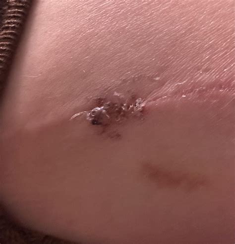 Stitches stuck in surgical glue? : r/Reduction