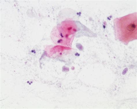 Trichomonas