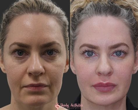 Botox Before And After Under Eyes