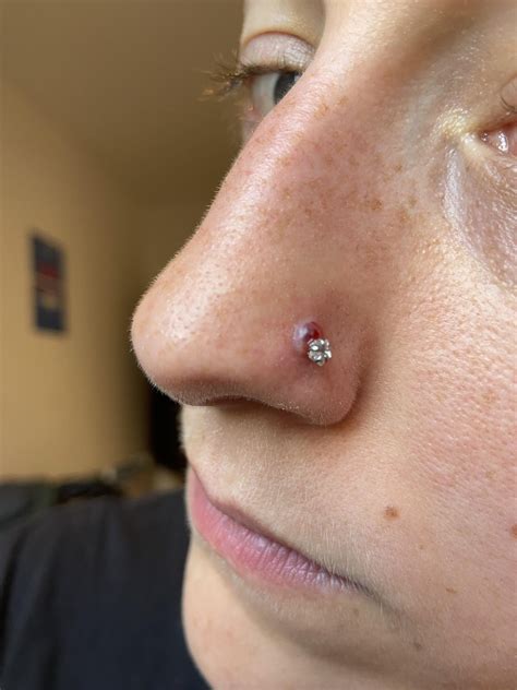 Infected Nose Piercing Bump Inside Nose