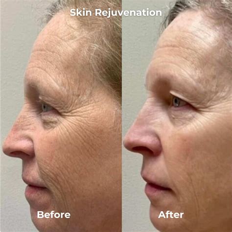 RF Microneedling Before & After Results