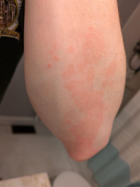 Elbows - rash? fungus? Eczema? : r/DermatologyQuestions