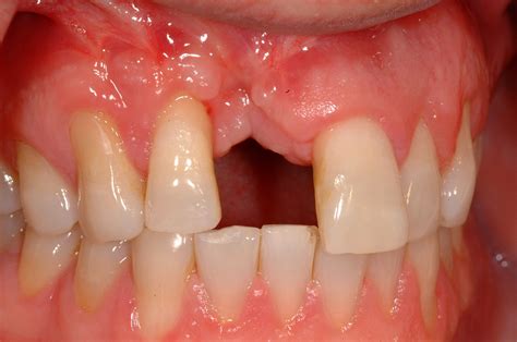 Types Of Dental Bone Graft Material at Isabel Spiegel blog