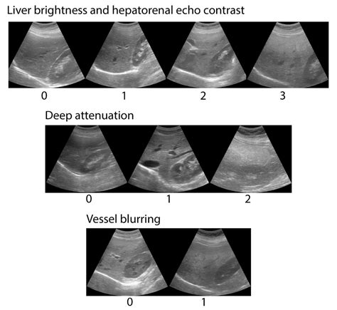 Accuracy of a Semi-Quantitative Ultrasound Method to Determine Liver Fat Infiltration in Early ...