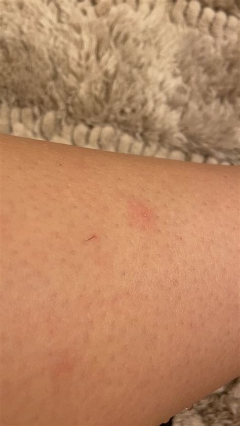 Combo leg pimple and ingrown hair : r/popping