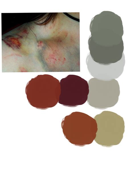 Bruised From Blood Draw - Drawing Tips Guide